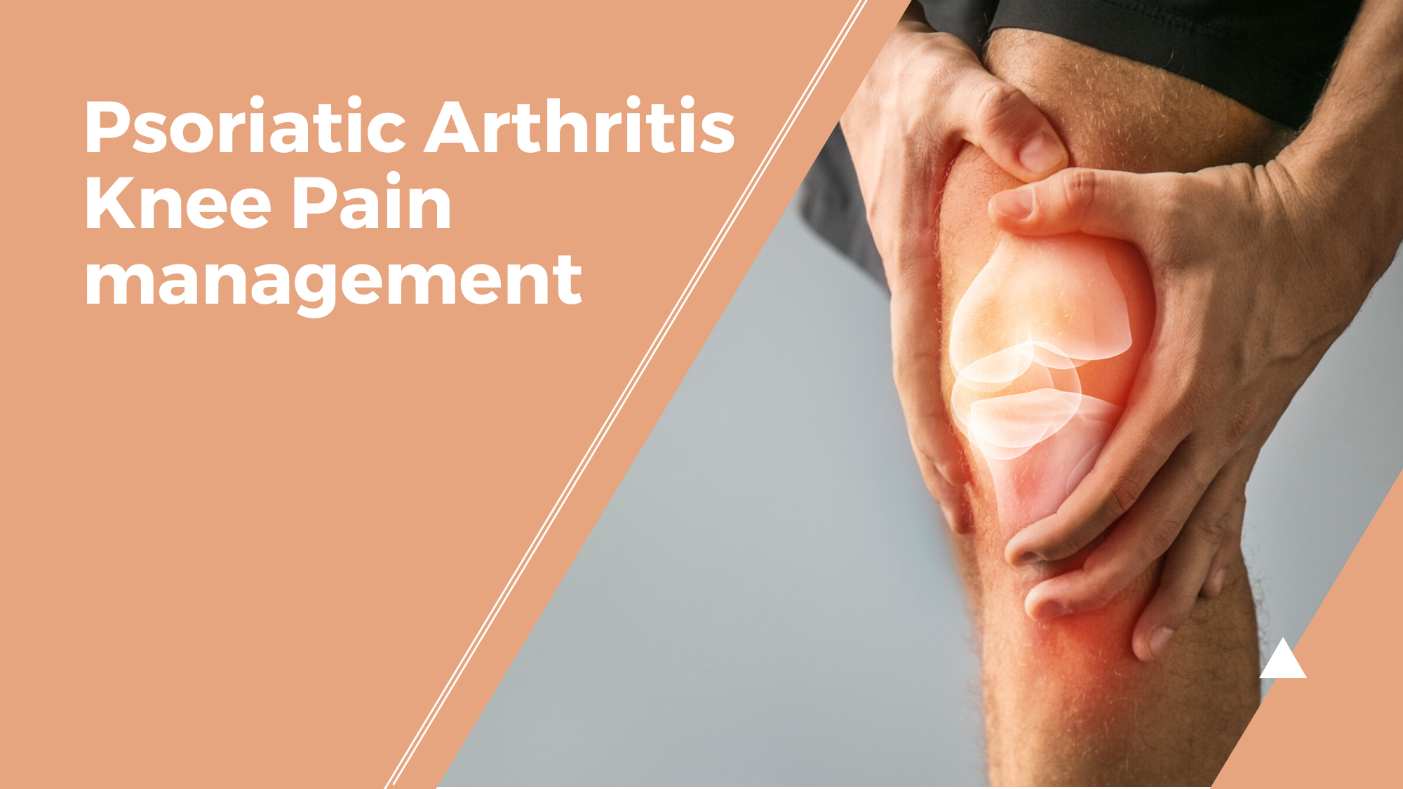 Psoriatic Arthritis Knee Pain management
